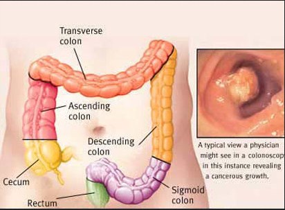 Signs and symptoms of intestine cancer